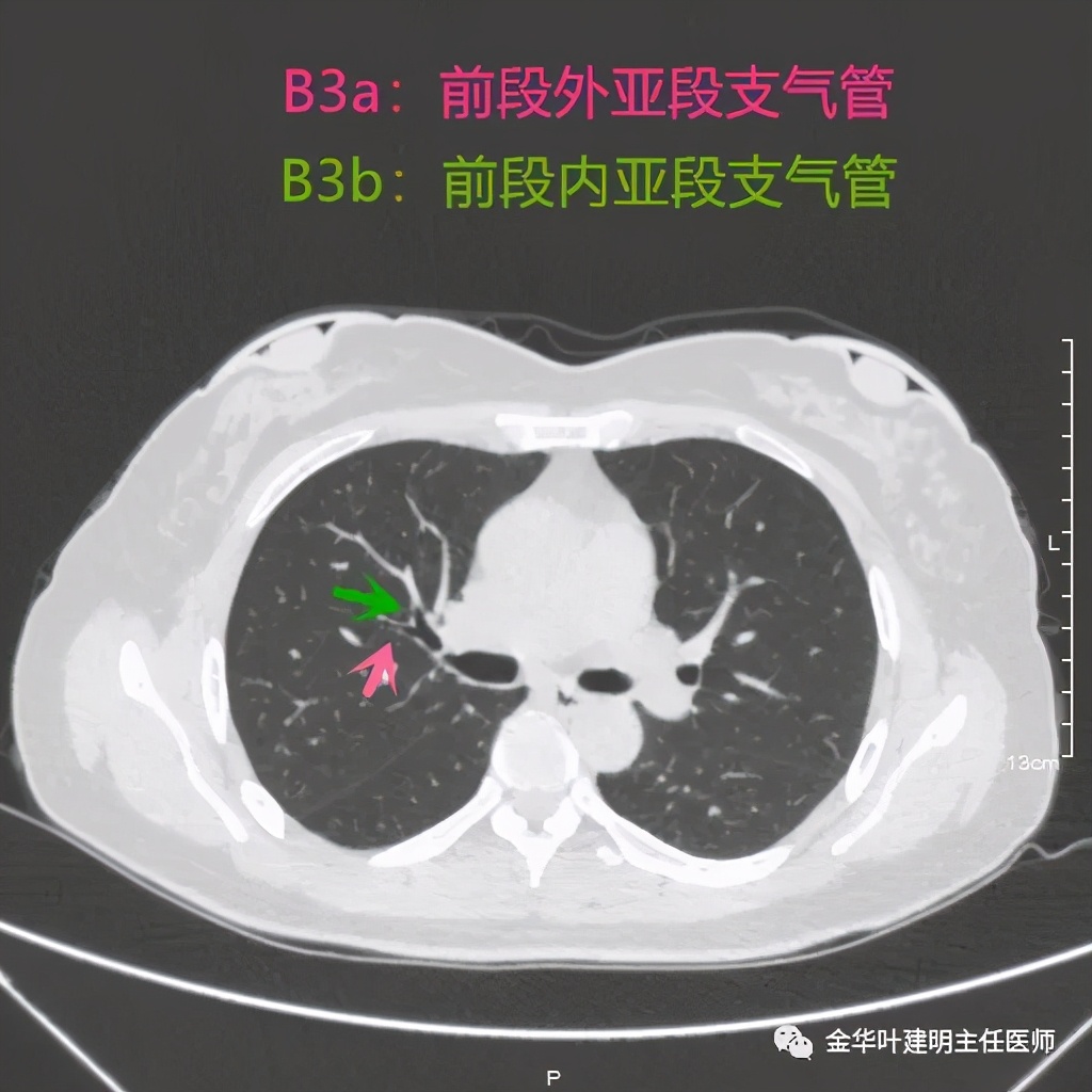 左肺上叶在ct影像上怎么看,平扫ct可以看出肺肿瘤的变化吗