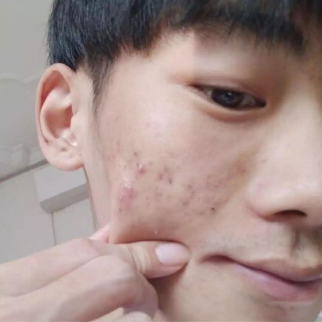 怎么祛痘祛痘印最有效的方法,如何快速祛痘祛痘印小妙招