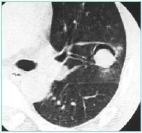 肺部ct十大征象,肺部ct正常图和异常图的区别