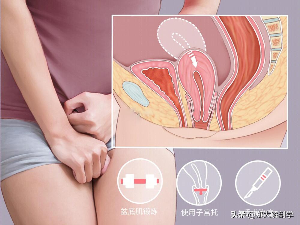 女性盆底功能障碍性疾病表现,盆底功能障碍会引起失眠吗