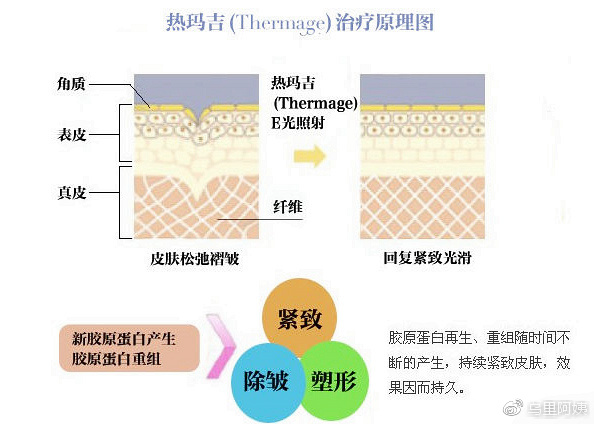 热玛吉机子的真伪怎么辨别,热玛吉5代怎么辨真伪