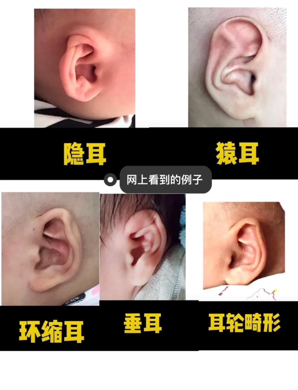 宝宝出生耳廓畸形但是听力正常,刚出生宝宝畸形耳朵图片