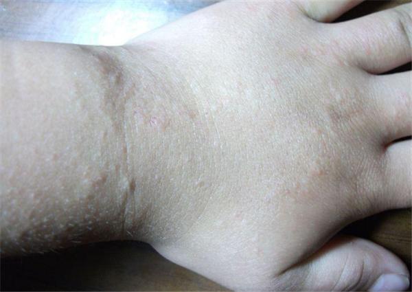 手上汗疱疹反复复发怎么办,手上汗疱疹反复发作怎么办