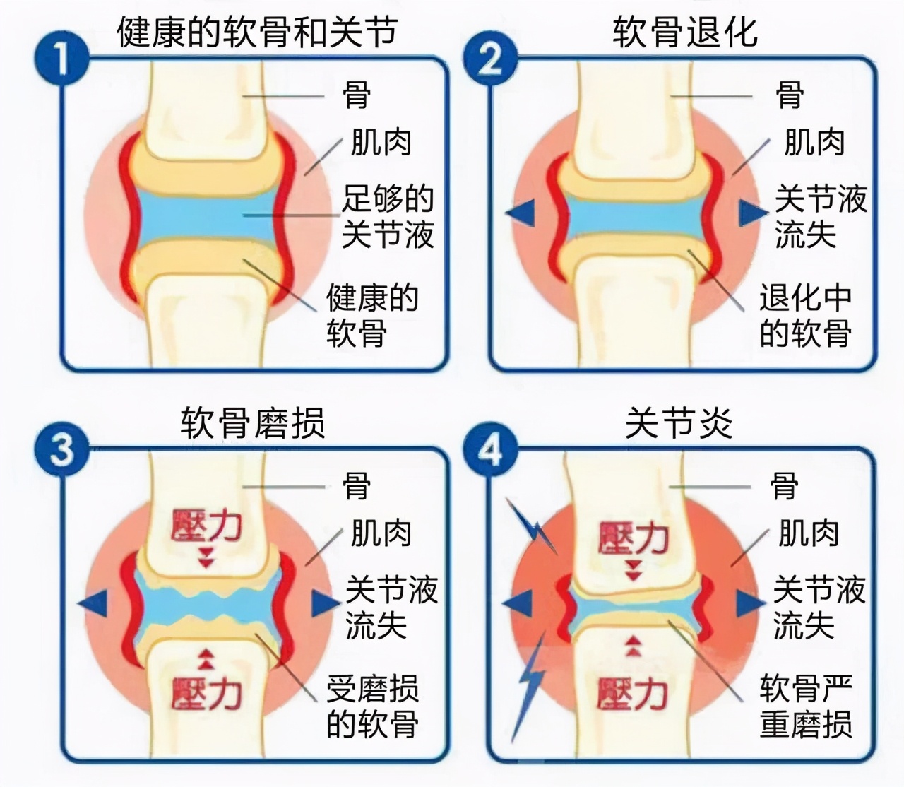 硫酸氨基葡萄糖与盐酸哪个效果好,硫酸氨基葡萄糖和软骨素哪个好