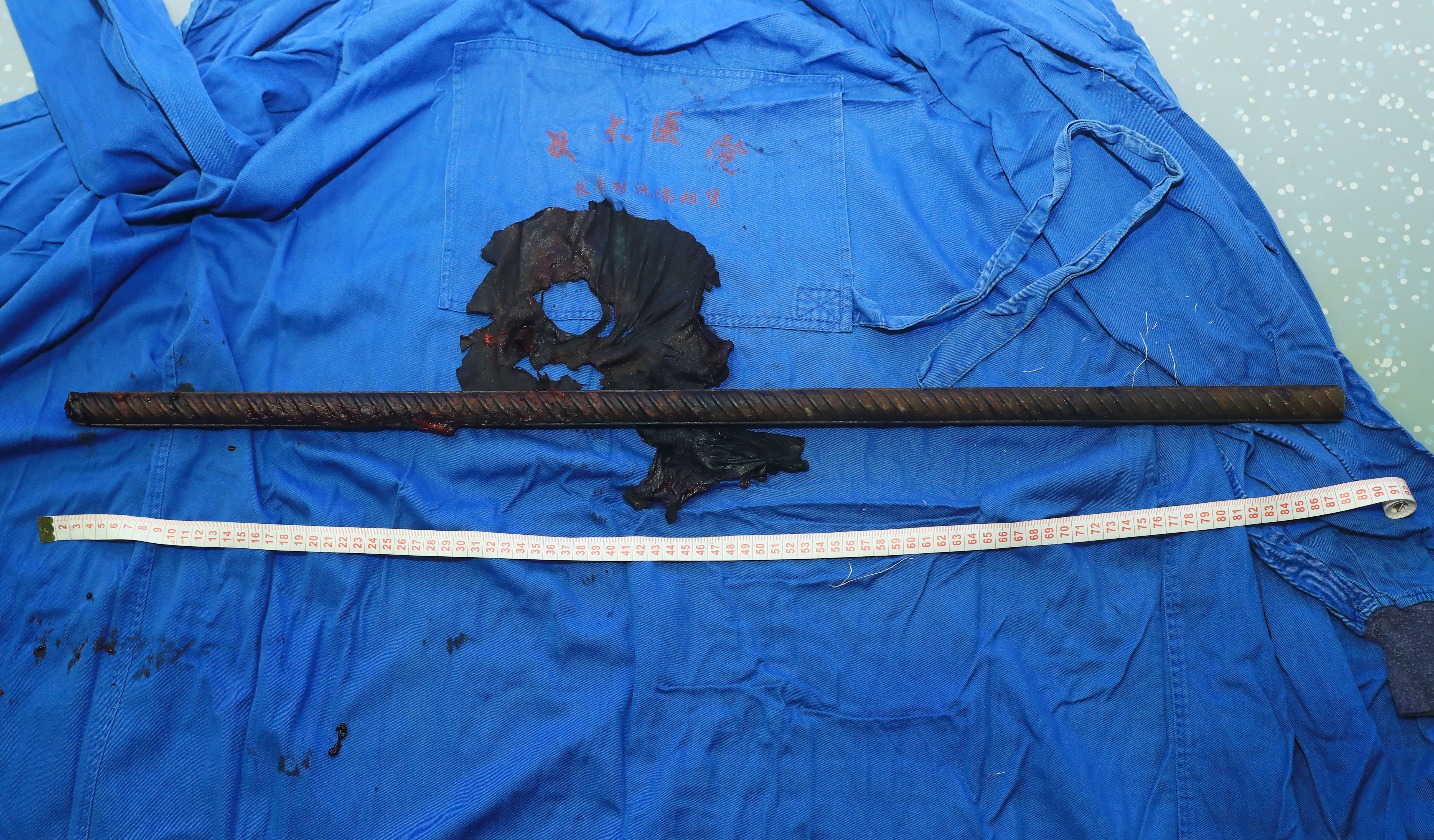 突发：90厘米长钢筋从会阴部插入穿腹入背结局：中大医院创伤中心多学科抢救化险为夷