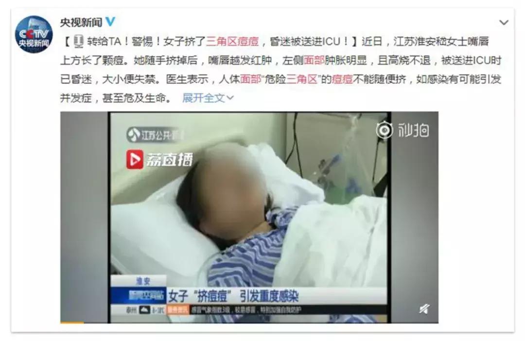 挤痘痘真的有危险吗,挤痘痘真的会致命吗