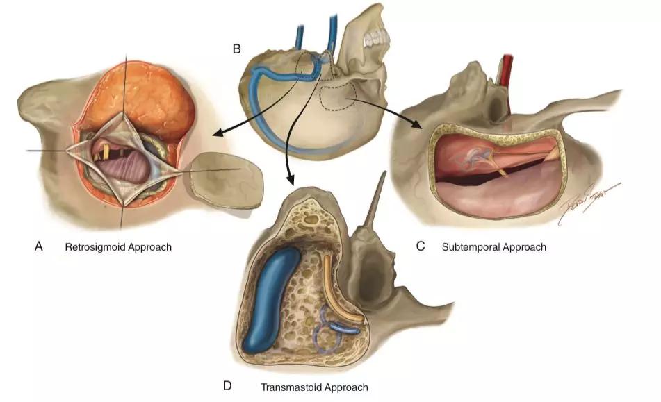 听神经瘤复发做二次手术,听神经瘤复发能要命吗