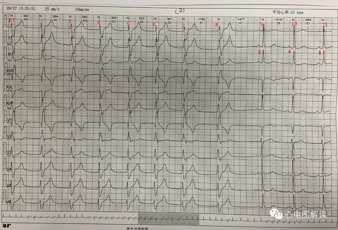 三度房室传导阻滞交界性逸搏,加速的室性逸搏心律的心电图表现