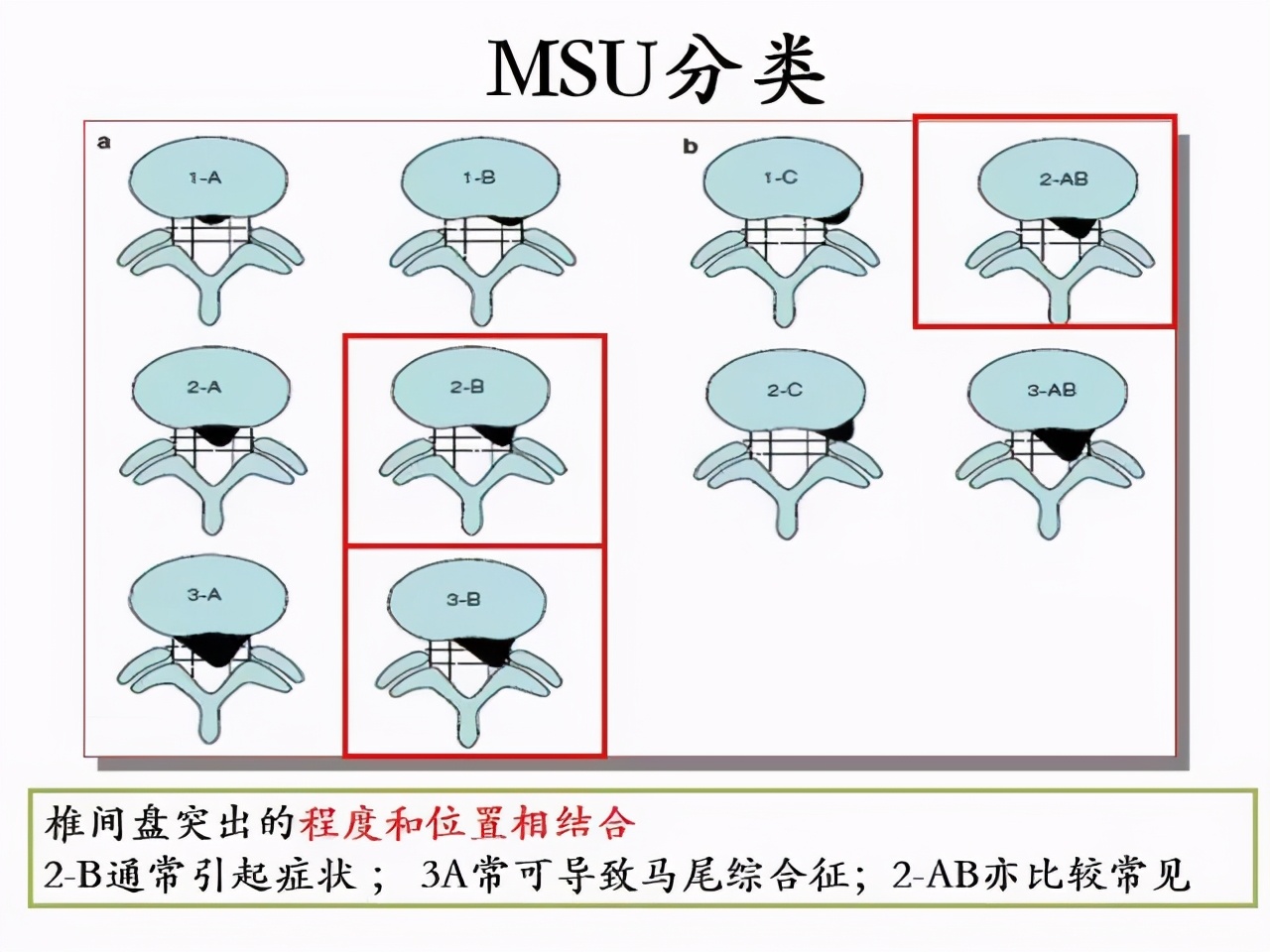 腰椎间盘突出手术后多久恢复正常,颈椎腰椎间盘突出最快的恢复办法