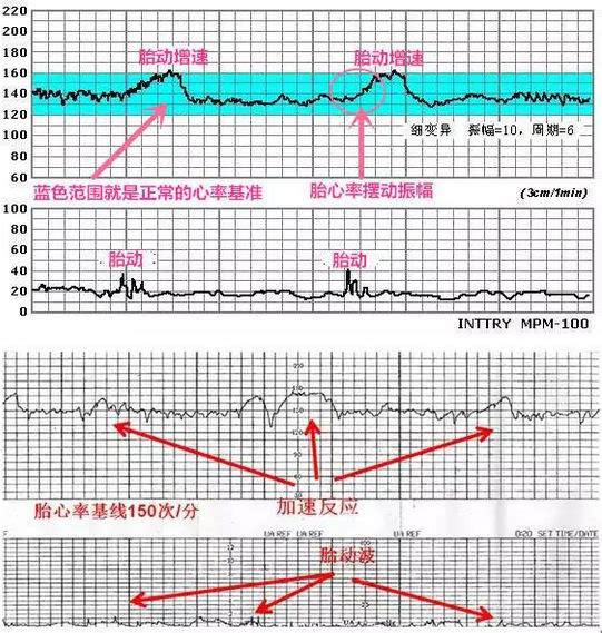 胎心监护时好时坏会是慢性缺氧吗,胎心监护能确定宝宝是否缺氧吗