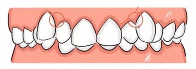 牙龈上有白色的牙垢刷不掉,牙龈里的黑东西