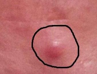 怎样祛痘印方法最有效,怎样祛痘印小妙招视频