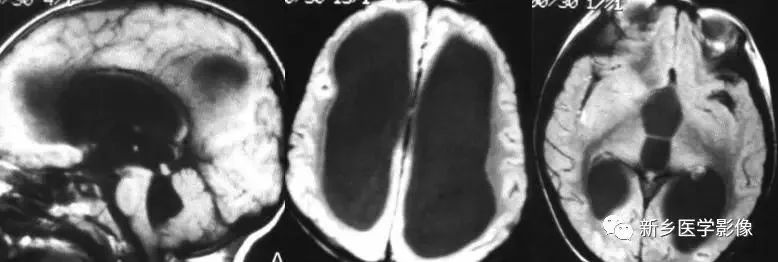 什么引起成人脑室扩大,哪些病可以导致左侧脑室增宽