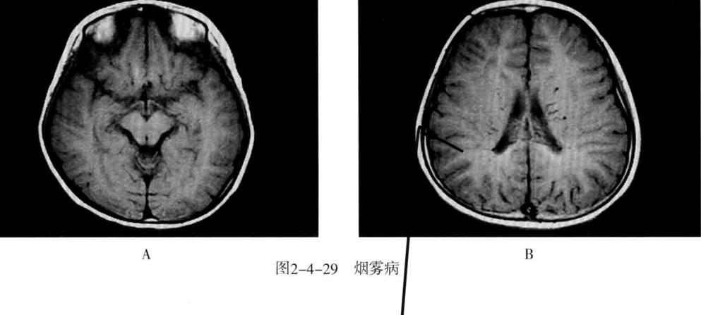 颅内血管周围间隙的影像鉴别,颅脑血管源性疾病影像诊断