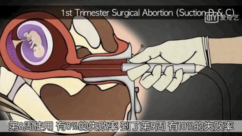 人流到底疼不疼,人流疼吗吓人吗