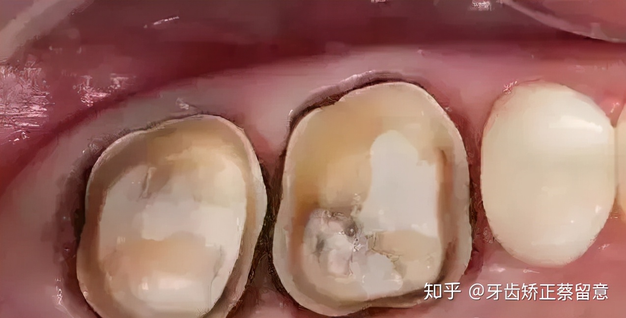 全瓷牙冠戴好了感觉咬合高了,戴了牙冠感觉大牙咬合不住