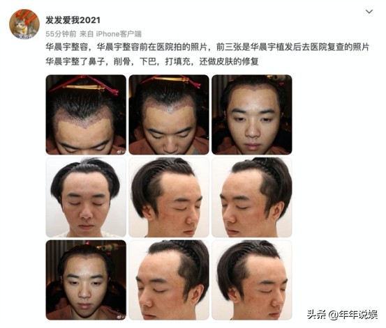 华晨宇被曝植发、整容,爆料者自称华晨宇老婆,还骂张碧晨是小三