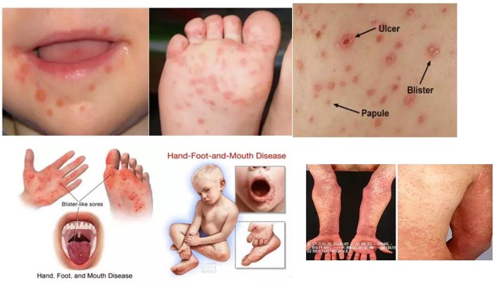 不明原因发热的常见原因及特点,长期不明原因的发热诊治经验