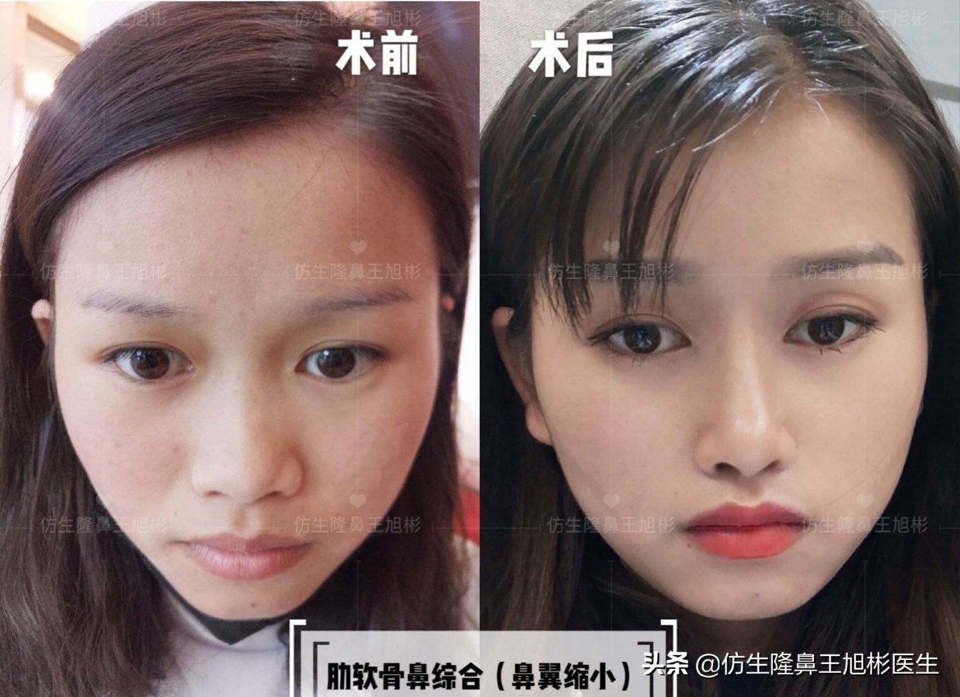 鼻头部位整形,鼻头圆钝高鼻梁整形案例