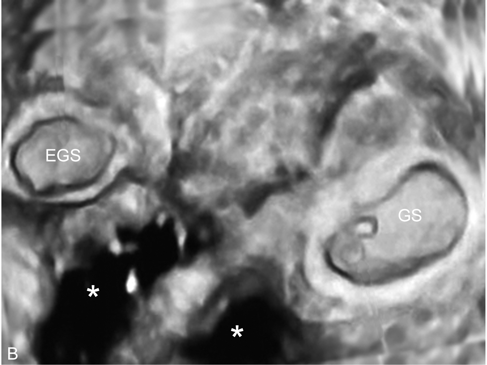 输卵管妊娠的典型超声表现为,输卵管妊娠的超声表现