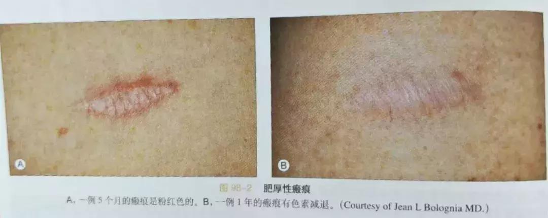 瘢痕体质如果要动手术怎么办,不太严重的疤痕体质能做手术吗