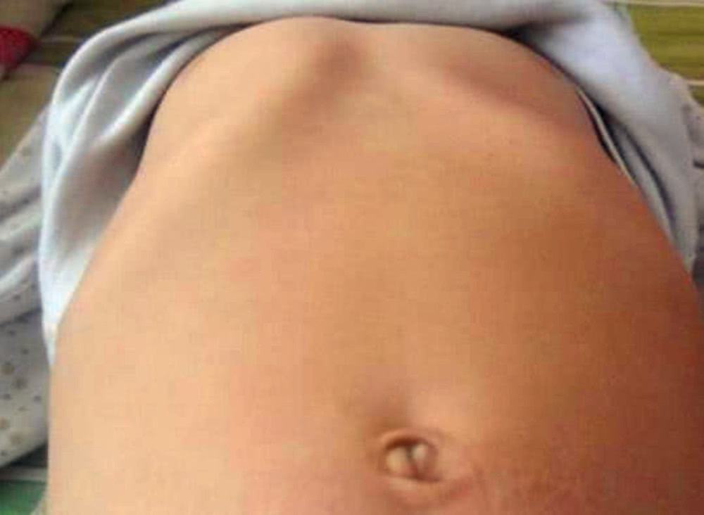 先心病手术后漏斗胸和鸡胸的区别,先天性心脏病开胸手术后鸡胸