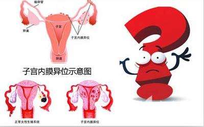 一文带你了解子宫内膜异位症,全面了解子宫内膜异位症
