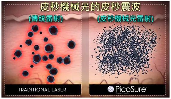 激光去青褐斑几次有效果,激光治疗斑点有效吗