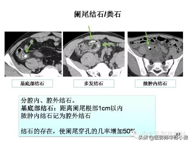 阑尾炎课件,阑尾炎的超声课件