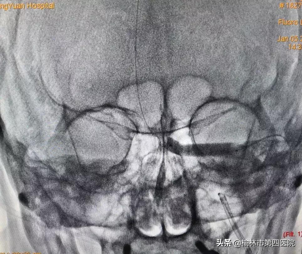 成功开展内瘘狭窄球囊扩张术,静脉窦狭窄手术