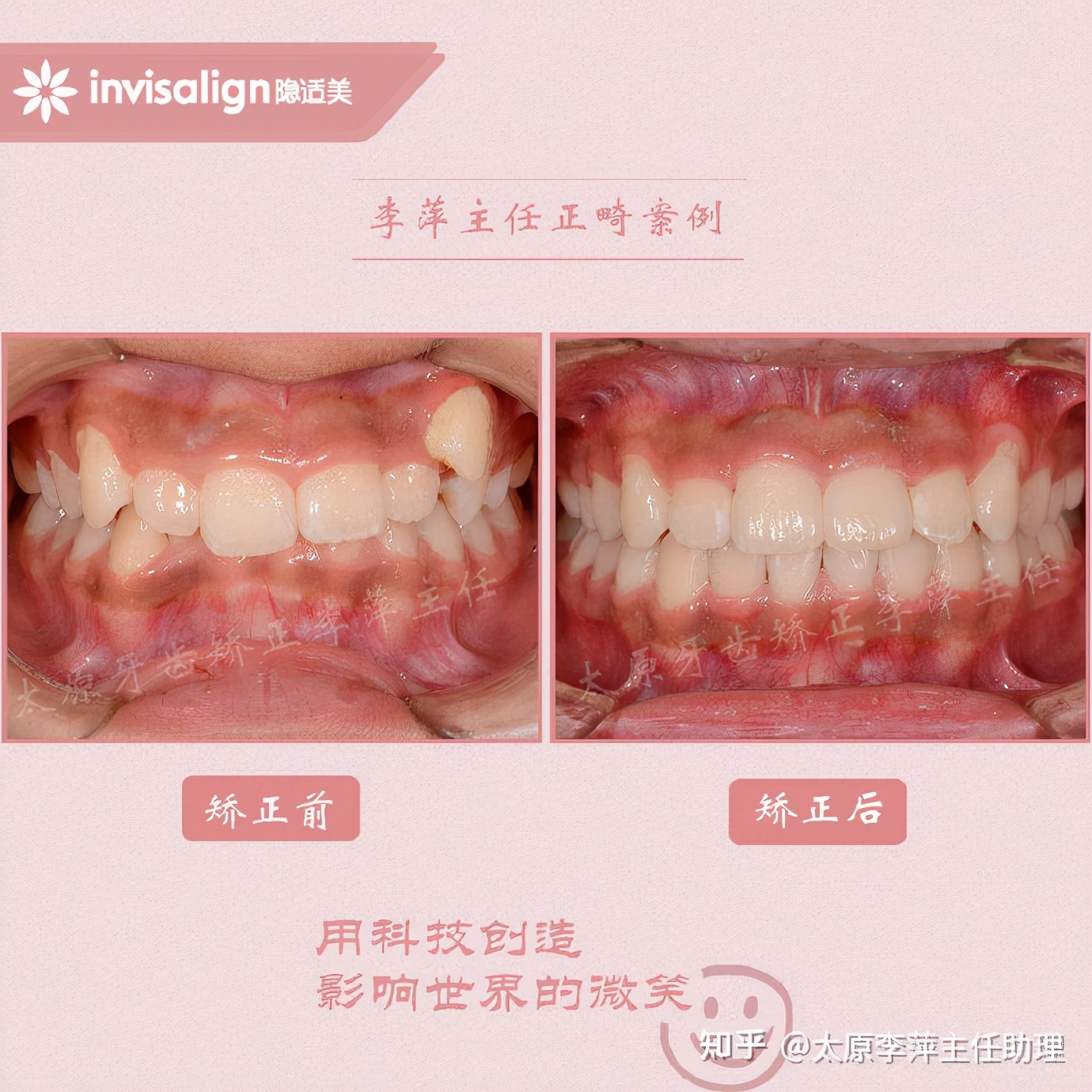 重度拥挤矫正牙齿适合隐形牙套吗,广州成人牙齿矫正推荐隐形牙套