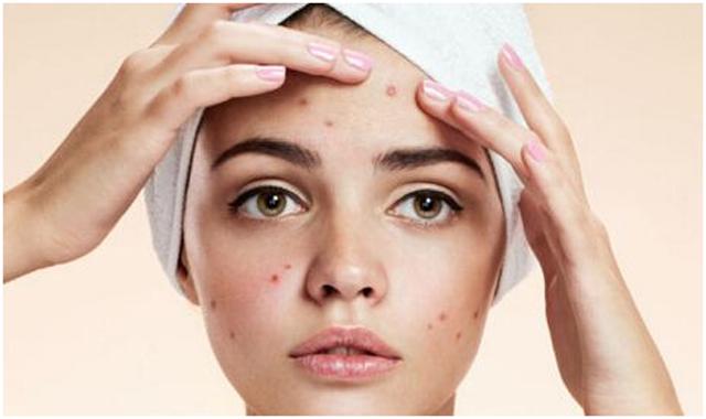教你一个最简单的方法去除痘印,怎样祛除痘痘和痘印最简单的方法