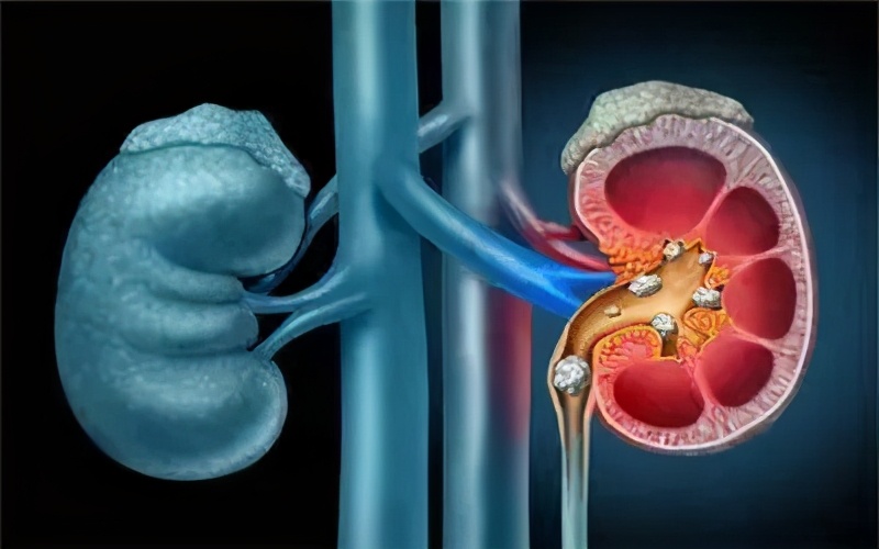 容易长肾结石不能吃些什么食物,吃什么食物容易导致肾结石发作