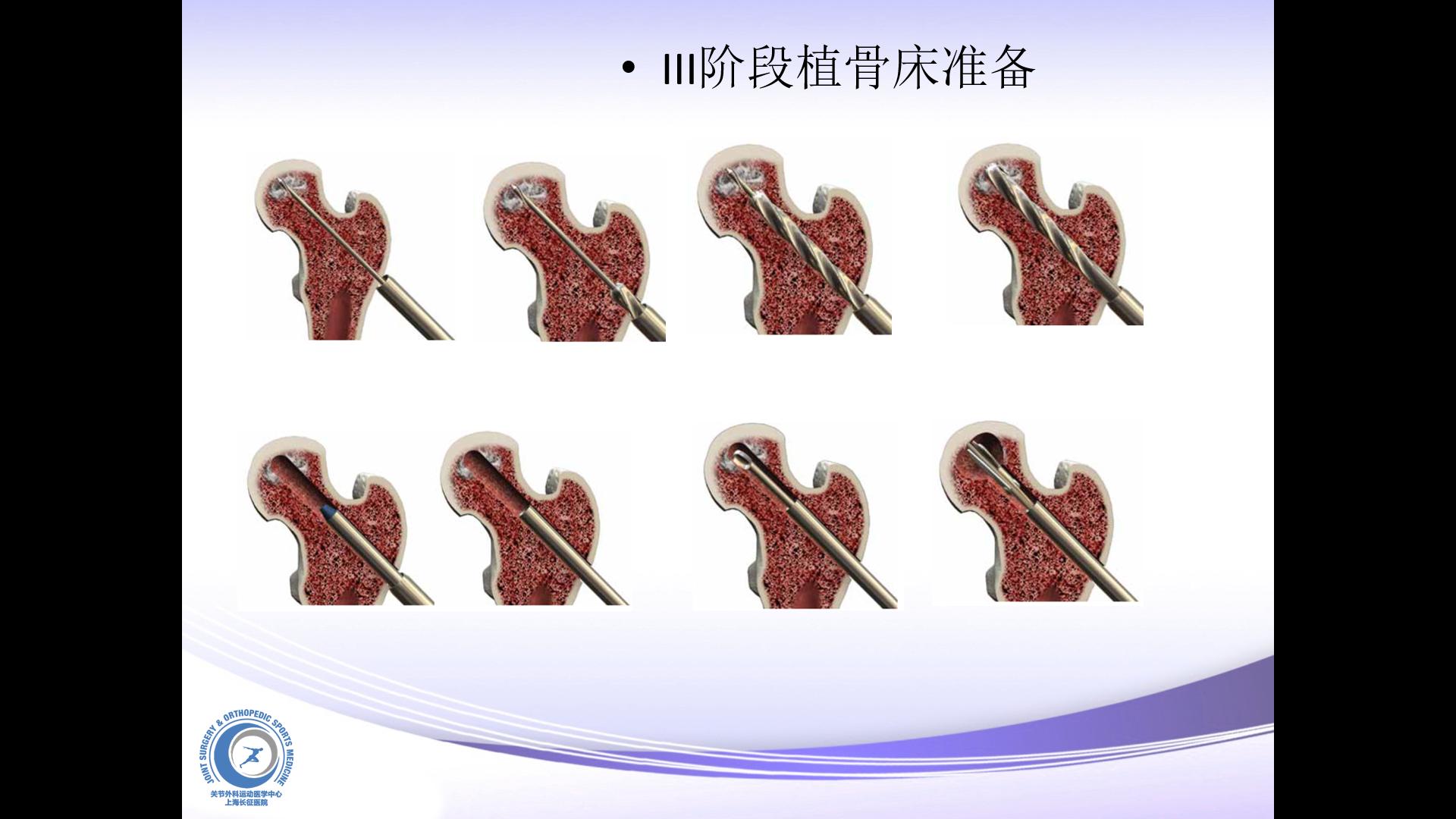 什么是股骨头坏死原因,股骨头坏死和股骨头缺血性坏死