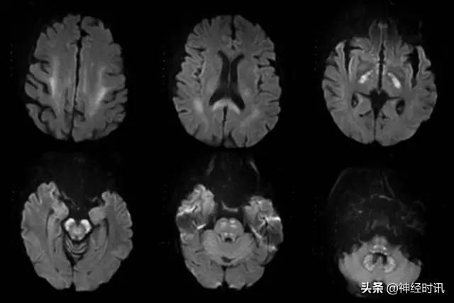 脑卒中病历诊断书图片,脑卒中影像判断技巧图解电子版