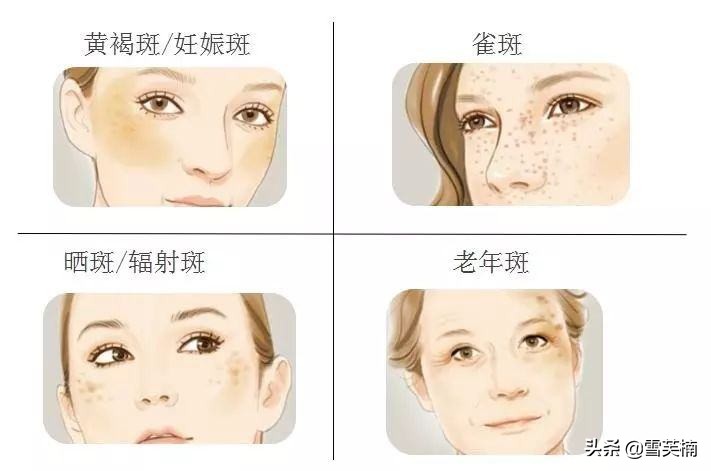 怎么去除褐斑最快最有效,褐斑怎么用药膏去除