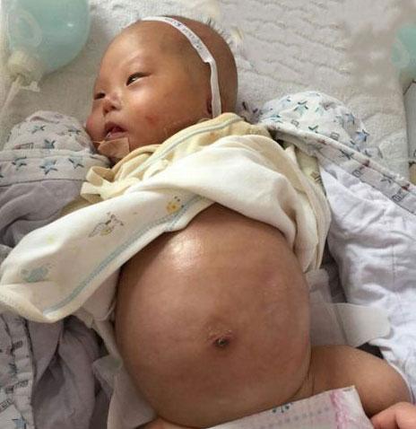 “无肛儿”，真是被诅咒的？