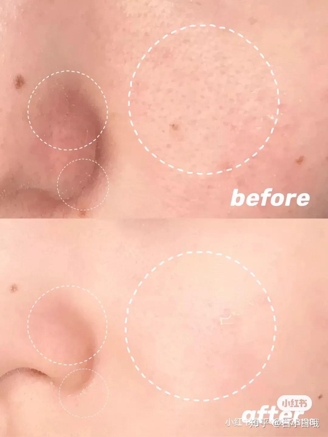 祛痘排行榜第一名祛痘产品芙清,芙清有哪些医用祛痘产品