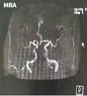 哪些药物会导致震颤,震颤病怎么回事