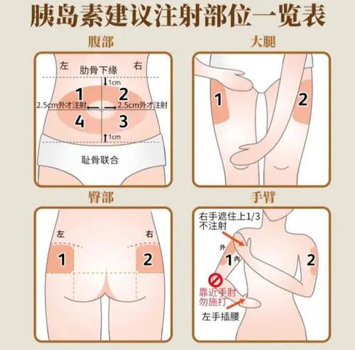 糖尿病引起的皮肤瘙痒药,治糖尿病的胰岛素泵使用方法