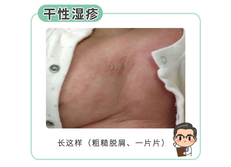 宝宝湿疹和妈妈过敏有关系么,干性湿疹热疹