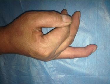 打篮球杵了下手指头，医生告诉要做手术？该不是小题大做吧