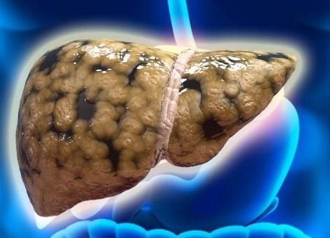 胆囊炎严重的话会导致什么病,胆囊炎的危害及会引发什么并发症