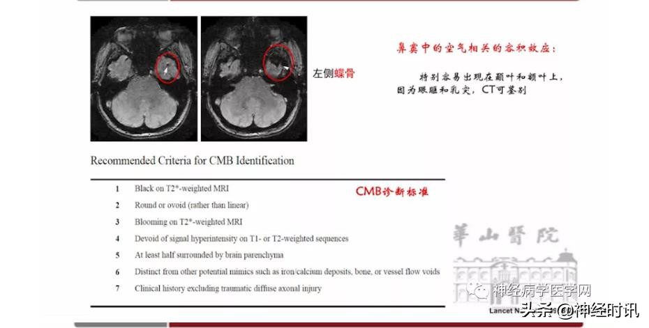 缺血性脑血管病出血评估,脑血管微出血怎么治疗