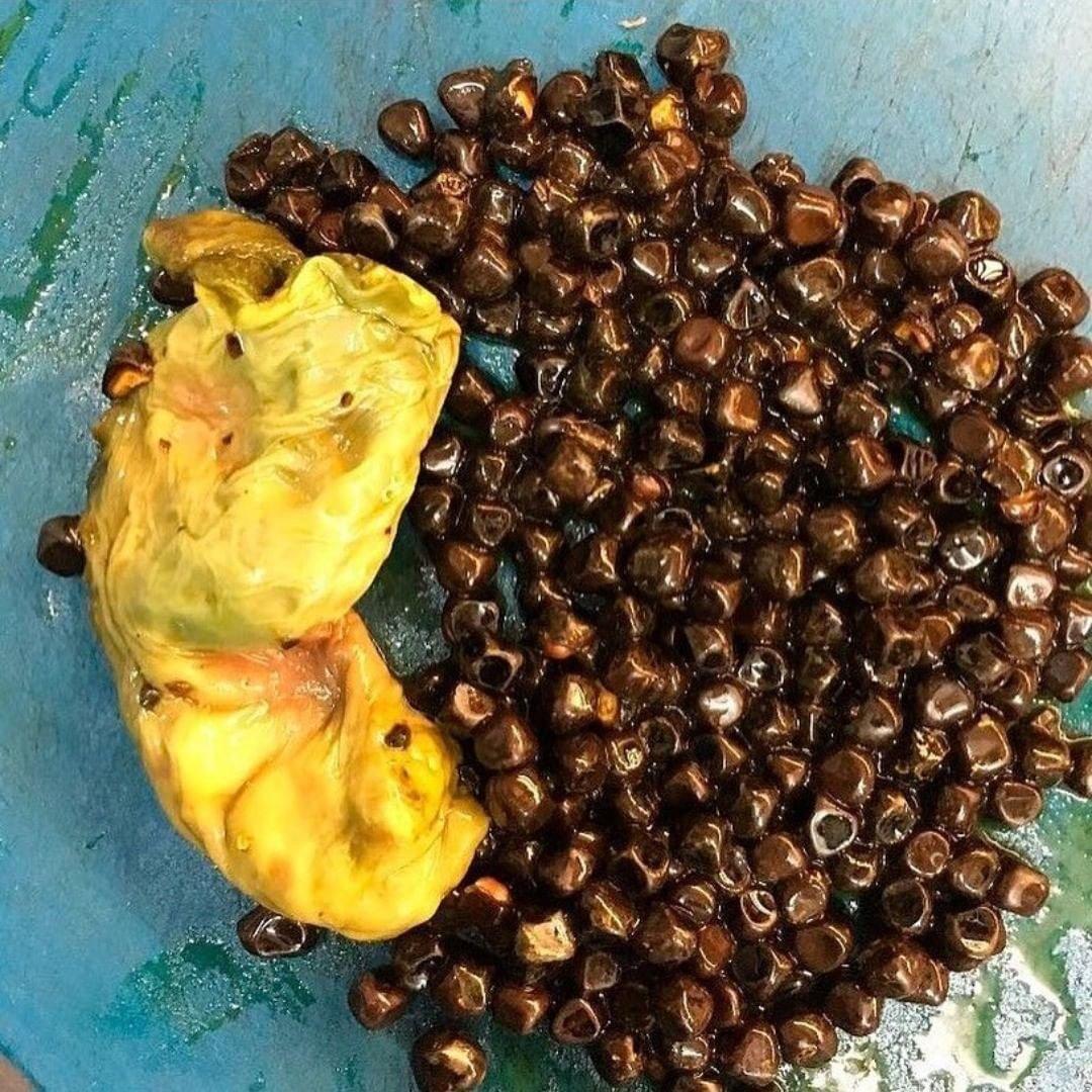 外科医生切下来的肉都到哪了,医生割下来的肉去哪里了