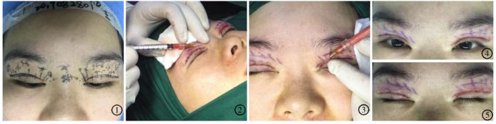 双眼皮改单眼皮案例,扇形双眼皮改平行双眼皮多少钱