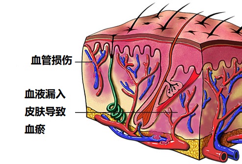 皮肤青紫淤痕怎么办,身上经常出现青紫瘀痕后果严重吗