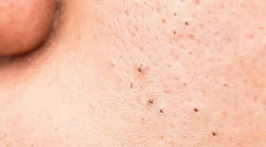 什么护肤品会越擦越黑,清洁毛孔黑头套装护肤品