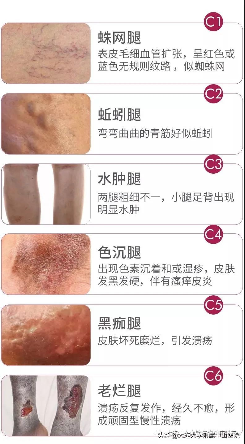 科普知识日间手术轻松搞定蚯蚓腿,日间手术知识科普