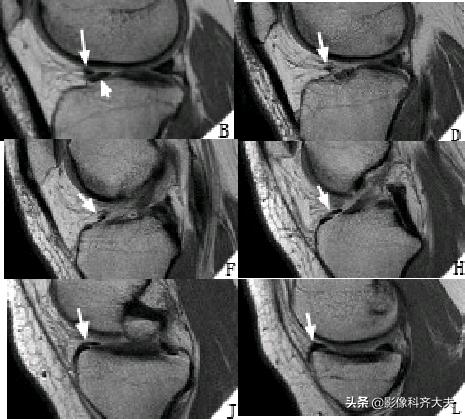 膝关节半月板损伤的磁共振,膝关节半月板病变的mri诊断与鉴别